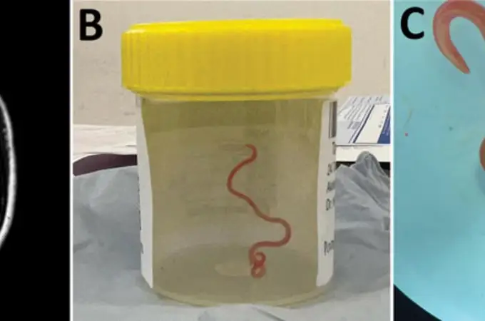 Detectan un gusano parásito de serpiente pitón de 8 centímetros en el cerebro de una mujer 