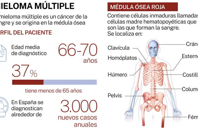La tercera revolución terapéutica del mieloma múltiple que España todavía no financia