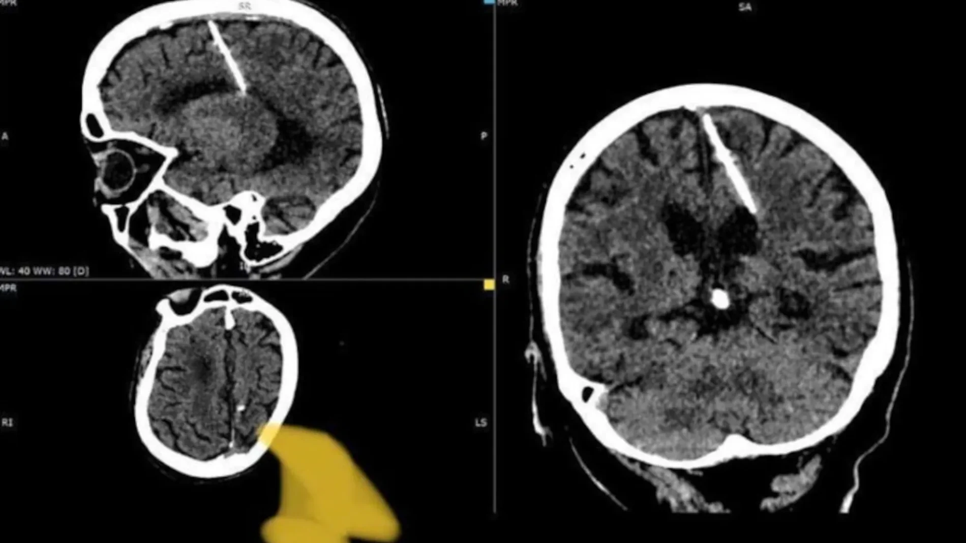 Descubren una aguja de 3 cm en el cerebro de una anciana rusa de 80 años