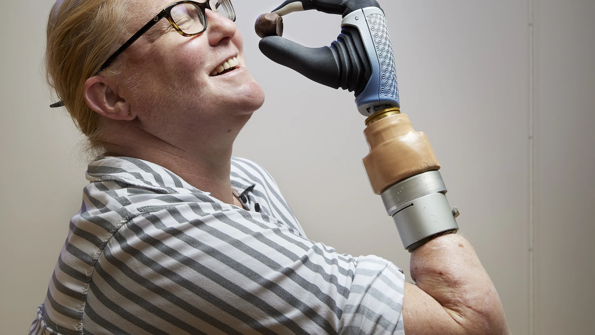 Primera persona con una amputación por debajo del codo que recibe una mano biónica conectada directamente a su sistema neuromusculoesquelético. 