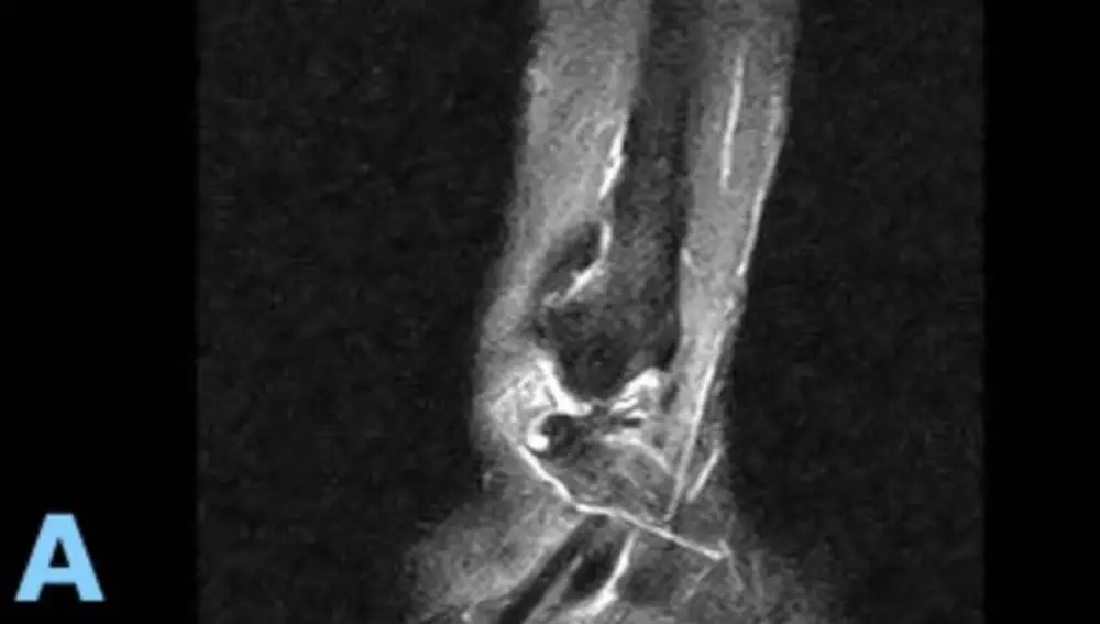 Radiografía del tobillo derecho de Fernando Adrián