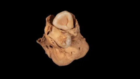 El tumor descubierto