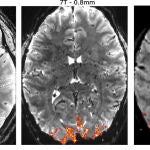Una comparación de escáneres cerebrales humanos utilizando el MRI NexGen 7T a una mayor resolución (izquierda) frente a un escáner convencional de 7T (centro) y el escáner estándar de 3T de un hospital (derecha). Con una resolución más alta, los neurocientíficos pueden localizar de manera más precisa las señales (naranja) en el cerebro para comprender la normal circuitaría cerebral y los cambios asociados con trastornos cerebrales.