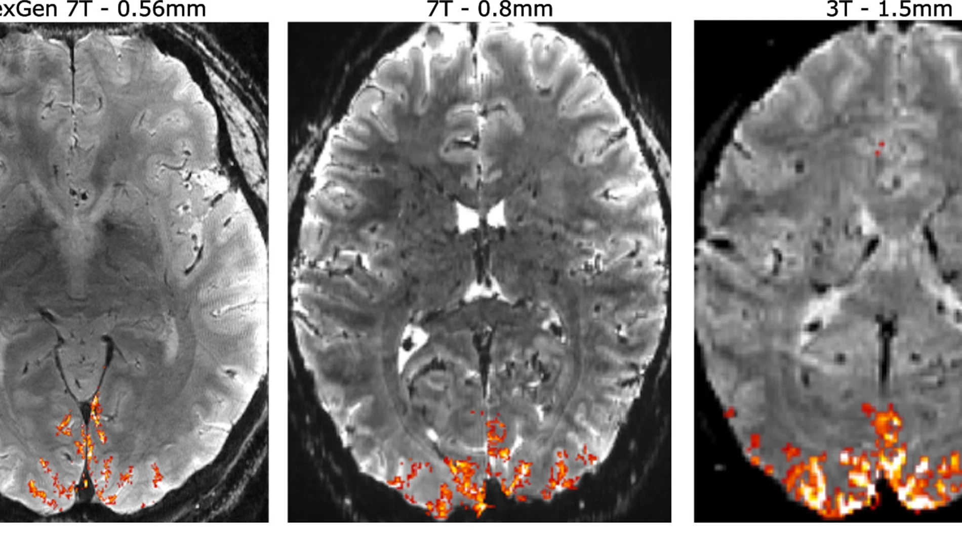 Una comparación de escáneres cerebrales humanos utilizando el MRI NexGen 7T a una mayor resolución (izquierda) frente a un escáner convencional de 7T (centro) y el escáner estándar de 3T de un hospital (derecha). Con una resolución más alta, los neurocientíficos pueden localizar de manera más precisa las señales (naranja) en el cerebro para comprender la normal circuitaría cerebral y los cambios asociados con trastornos cerebrales.