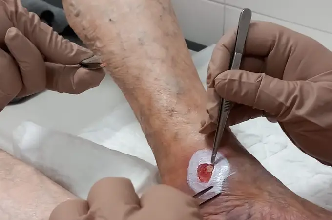 La novedosa técnica para curar heridas que nunca cicatrizan