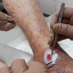 Un CAP de Martorell (Barcelona) prueba una técnica de microinjertos de piel para heridas crónicas