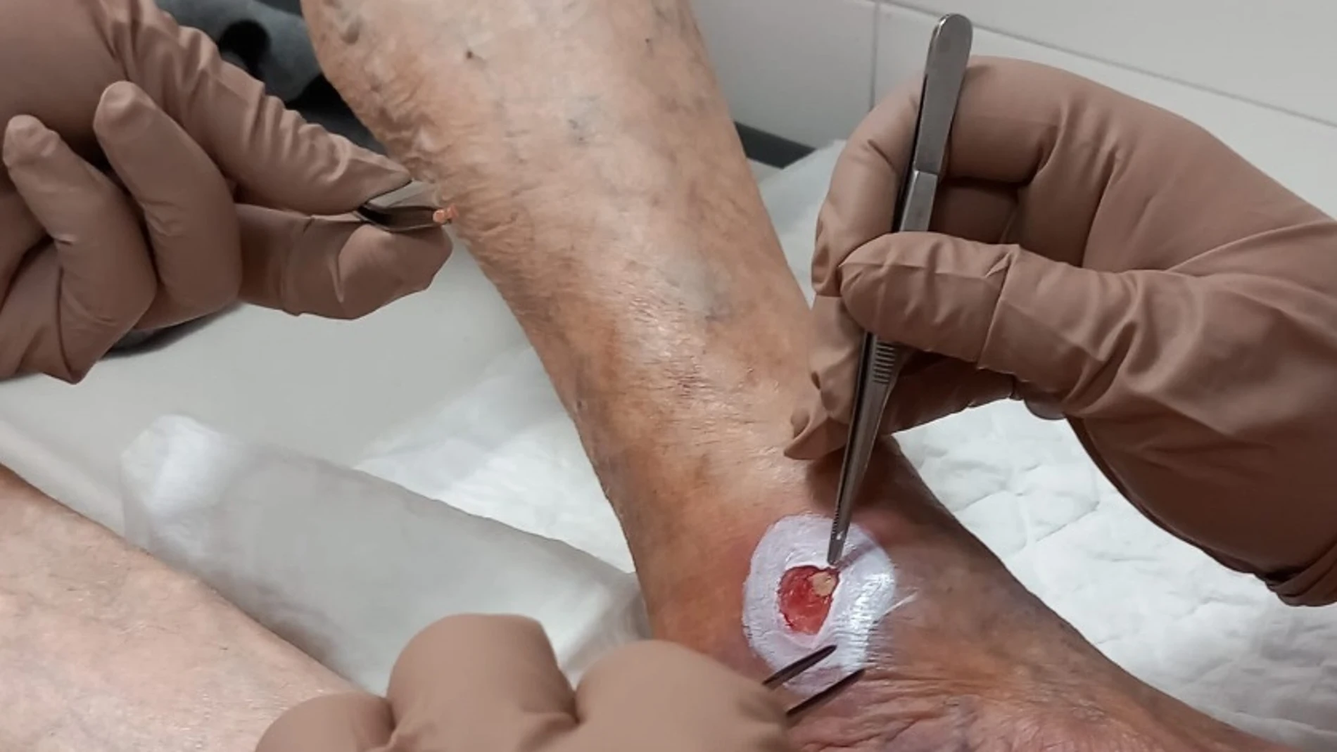 Paciente tratado con la técnica de microinjertos de piel para tratar heridas crónicas GOVERN 07/12/2023