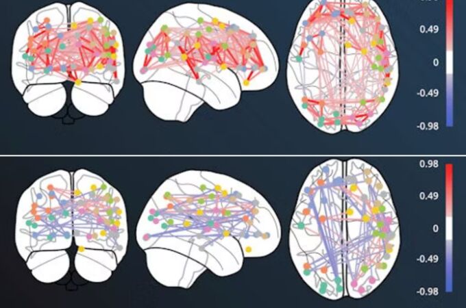 Efectos en la cnectividad neuronal antes (arriba) y después de usar ketamina. 