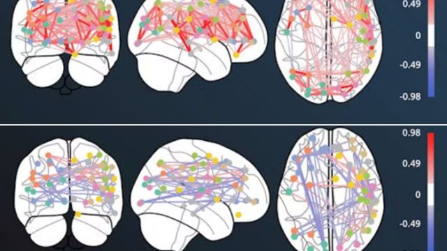 Efectos en la cnectividad neuronal antes (arriba) y después de usar ketamina. 