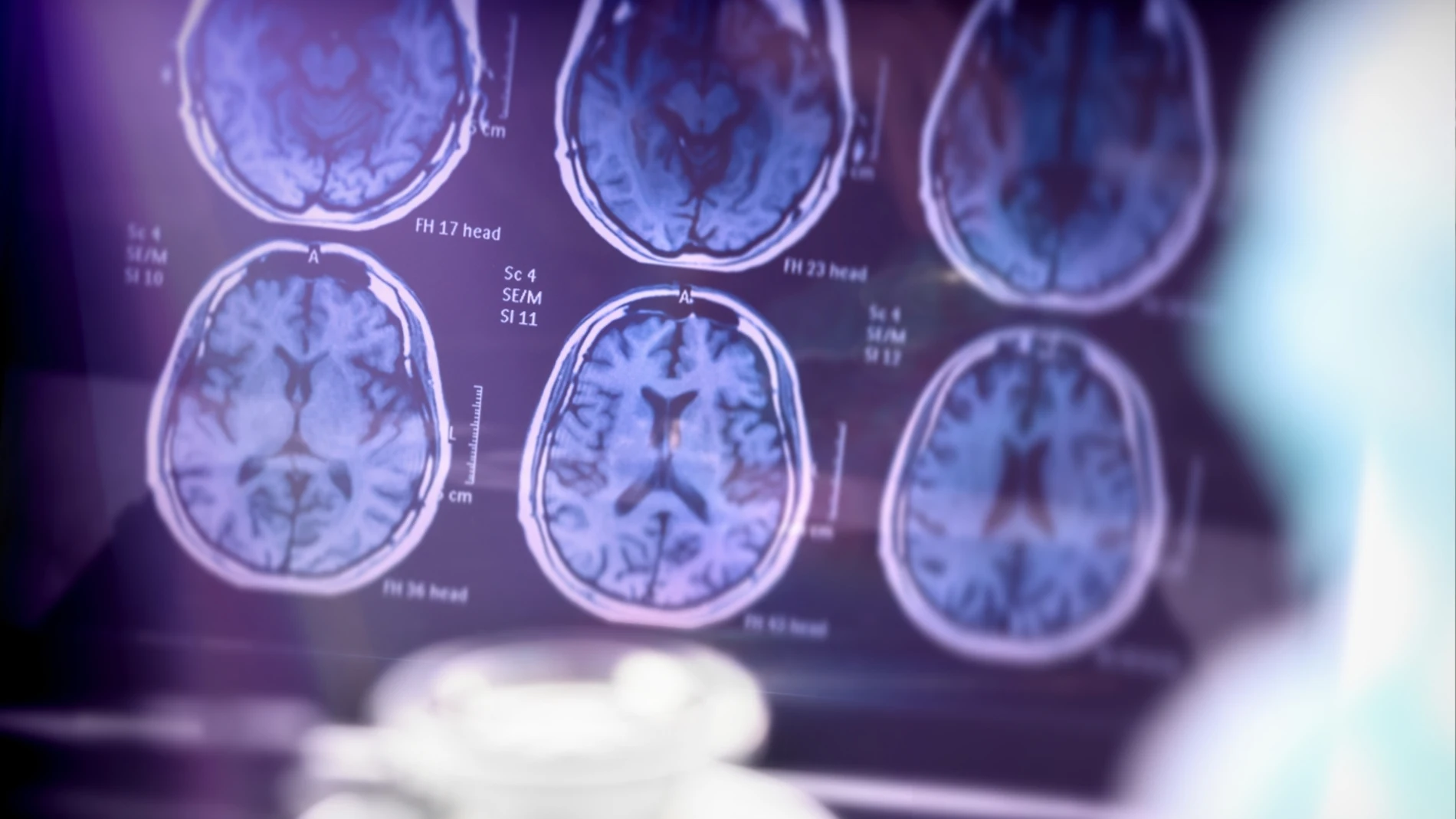 Científicos holandeses descubren cinco variantes del Alzheimer que requieren tratamientos diferenciados