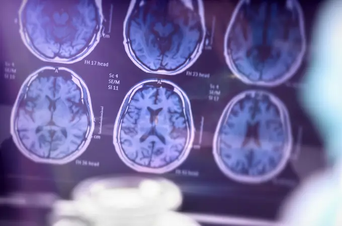 Investigadores británicos identifican nuevo objetivo para el tratamiento del Alzheimer