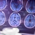 Científicos holandeses descubren cinco variantes del Alzheimer 