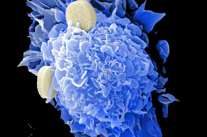 El cáncer de próstata no es una sola enfermedad: se divide en dos tipos. «Esto podría salvar miles de vidas»
