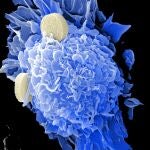 El cáncer de próstata no es una sola enfermedad: descubren que se divide en dos tipos