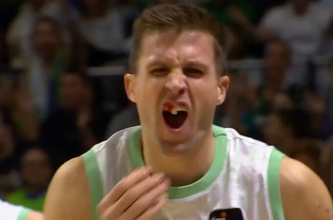 El brutal golpe que dejó sin dientes a un jugador del Bilbao Basket