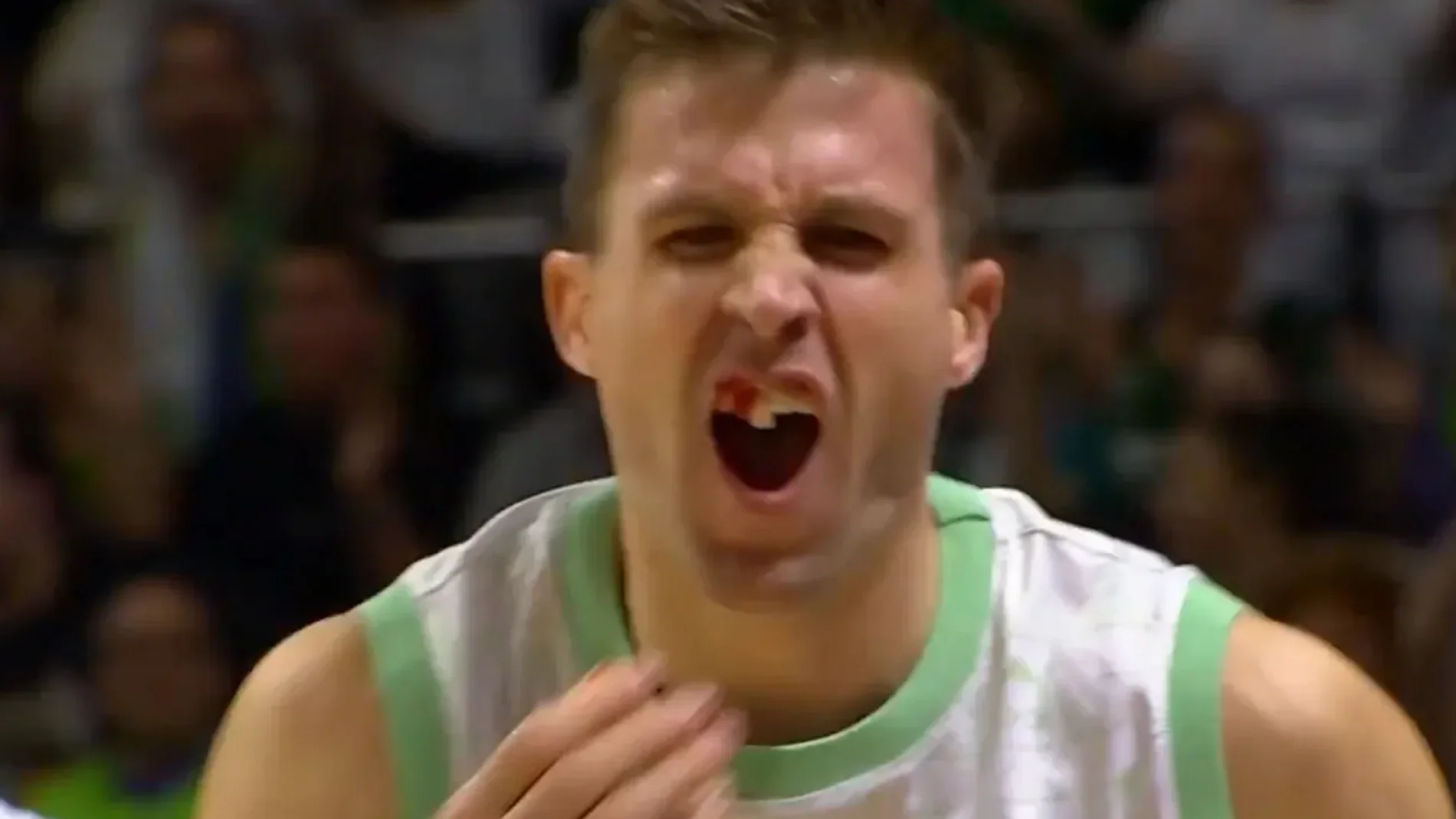 El brutal golpe que dejó sin dientes a un jugador del Bilbao Basket