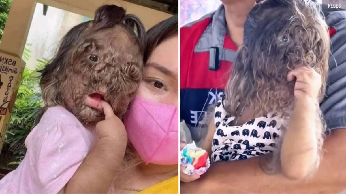 Adik Missclyen, la niña de dos años que se hizo viral por sufrir el 