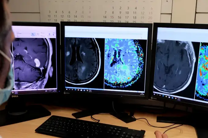 Desarrollan una herramienta de IA capaz de mejor el diagnóstico de tumores cerebrales