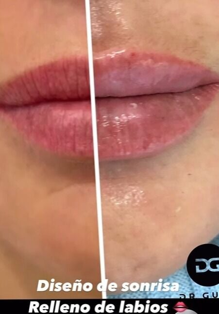 Los labios de Olga Moreno, antes y después 