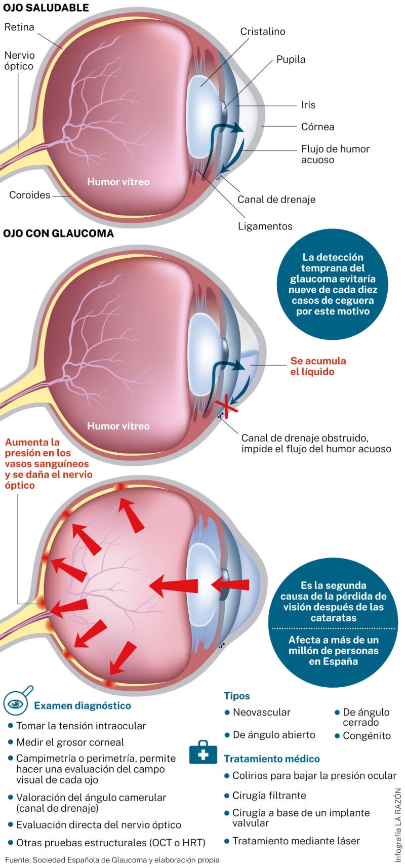 Glaucoma