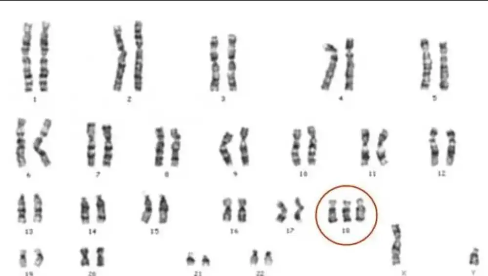 cuando el cromosoma 18 tiene una copia de más, se produce el Síndrome de Edwards.