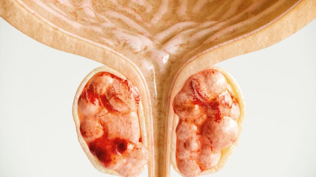 Cáncer de próstata