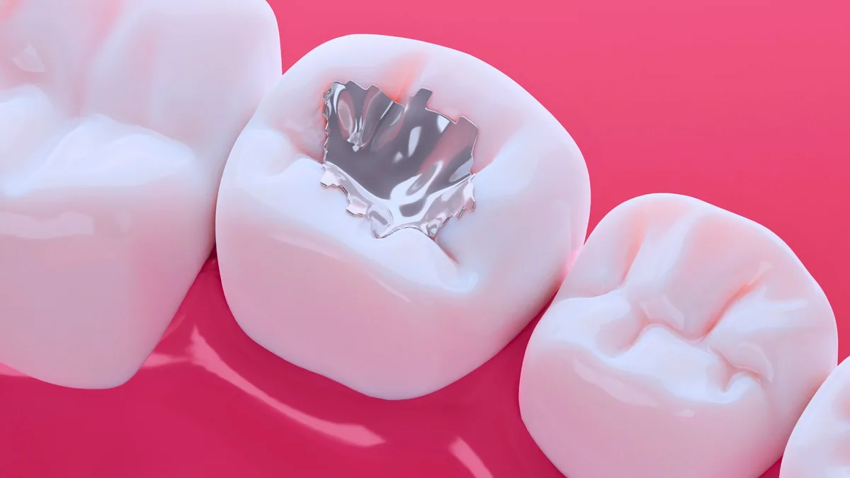Preocupación entre los dentistas por el fin de los empastes de mercurio: prohibidos desde 2025