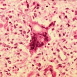 Células infectadas por el virus del sarampión