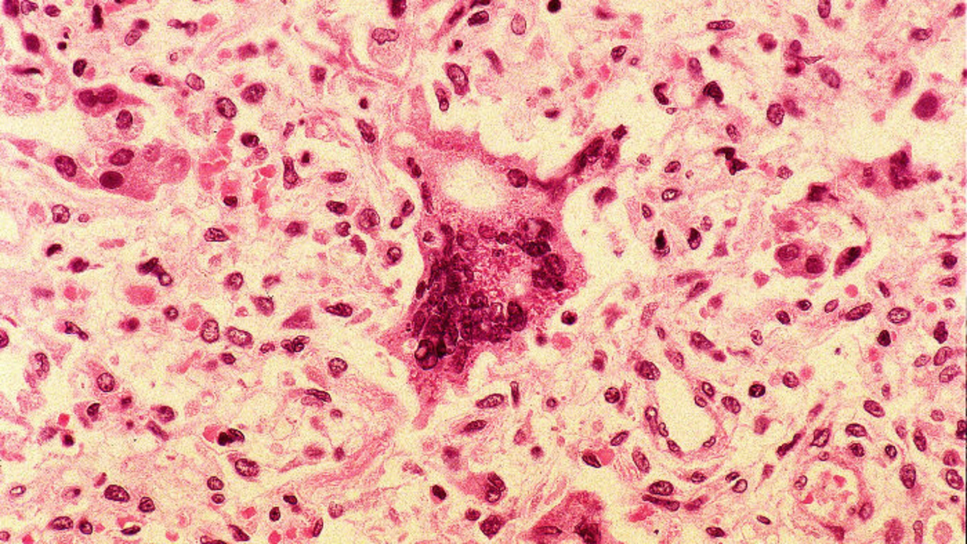 Células infectadas por el virus del sarampión