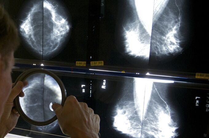 Un radiólogo usa una lupa para revisar mamografías en busca de cáncer de mama.