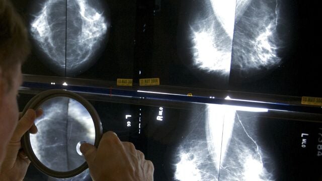 Un radiólogo usa una lupa para revisar mamografías en busca de cáncer de mama.