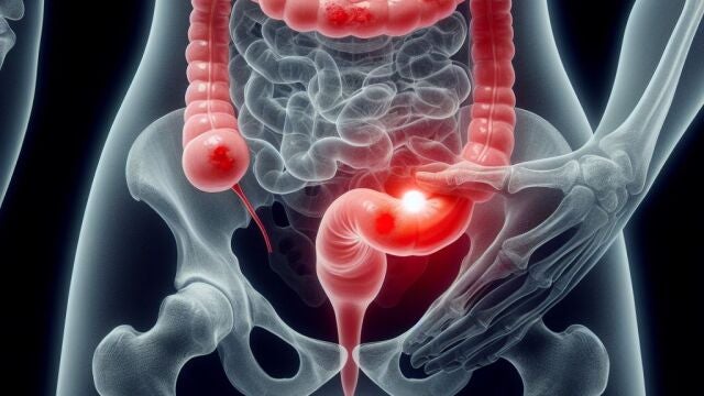 El cáncer colorrectal es el tumor maligno más frecuente en España y el segundo en tasa de mortalidad 