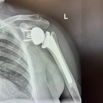 Imagen de una prótesis de hombro