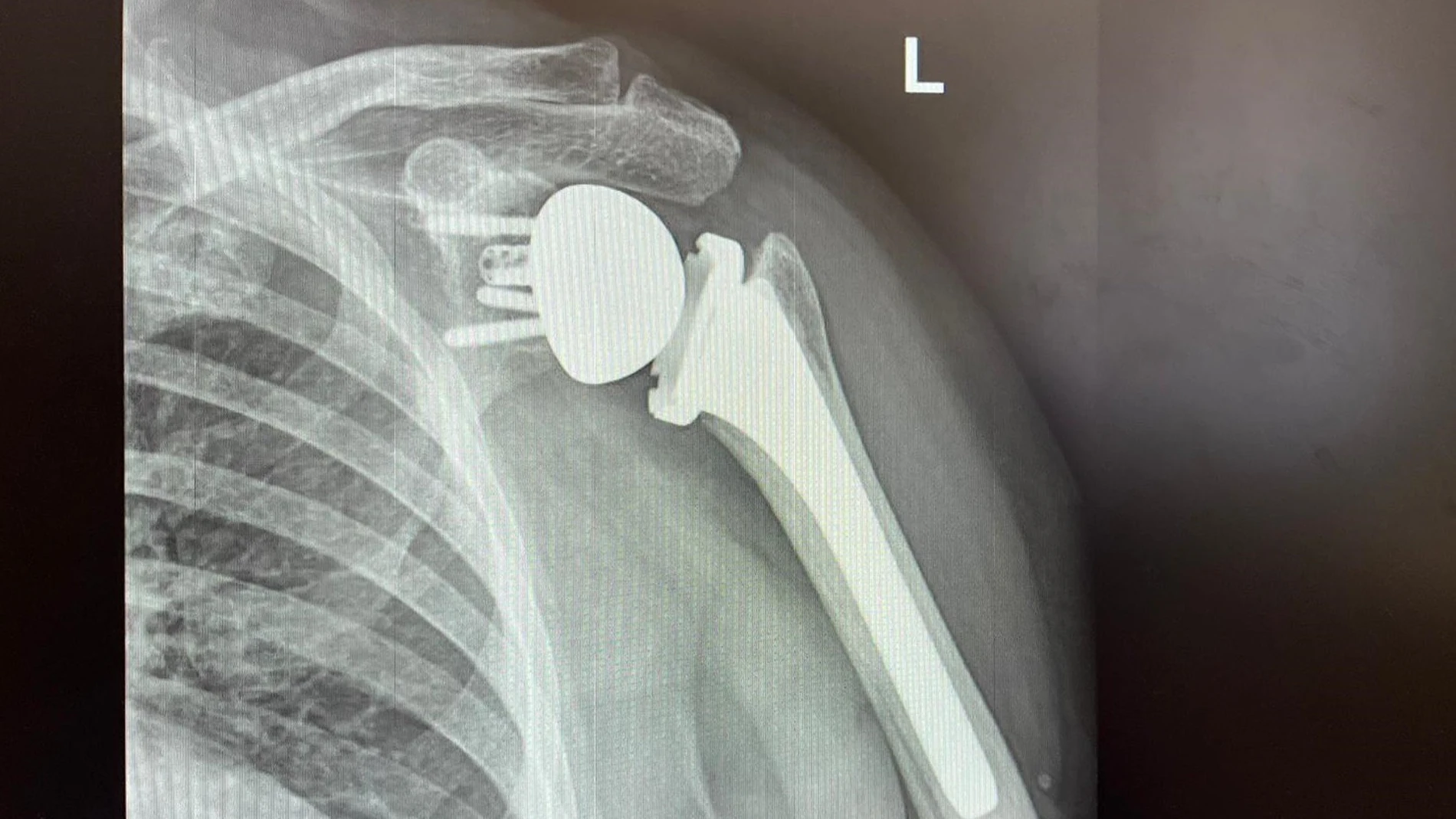 Imagen de una prótesis de hombro