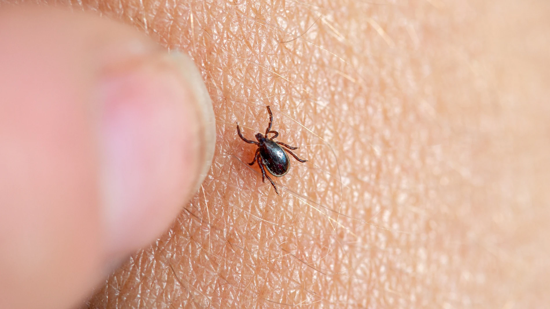 Imagen de una garrapata marrón en la piel humana con un dedo femenino a punto de retirarla.