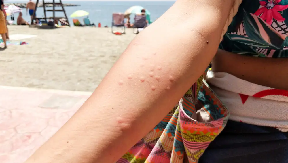 Las picaduras de medusa no deben frotarse y han de aclararse con agua dulce