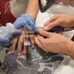 Retiran un anillo atascado en el dedo de un adolescente en Murcia