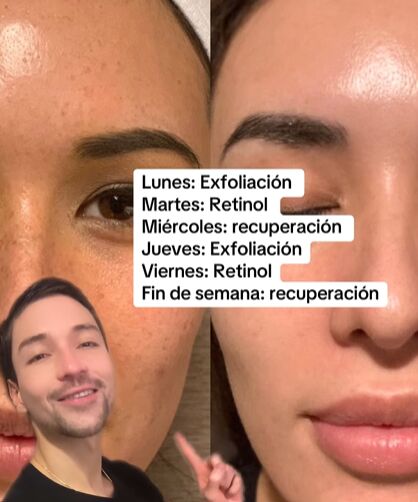 Ácido glicólico vs. retinol.