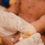 ACNUR advierte de los efectos del brote de mpox para los refugiados y las familias desplazadas en países afectados