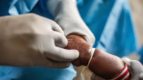 Unicef advierte de consecuencias de la mpox sobre la infancia en Burundi: "Los niños se han llevado lo peor"