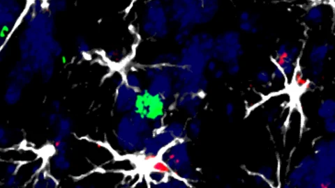 Células alrededor de una metástasis cerebral.
