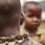 Salud.- El mpox se ceba con los niños en África, aunque las lecciones aprendidas con la COVID-19 frenan su expansión