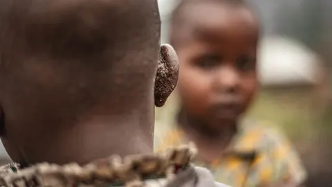 Mpox se ceba con los niños en África, aunque las lecciones aprendidas con la COVID-19 frenan su expansión