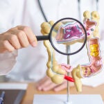 El cáncer colorrectal es el tumor maligno más frecuente en España y el segundo en la tasa de mortalidad