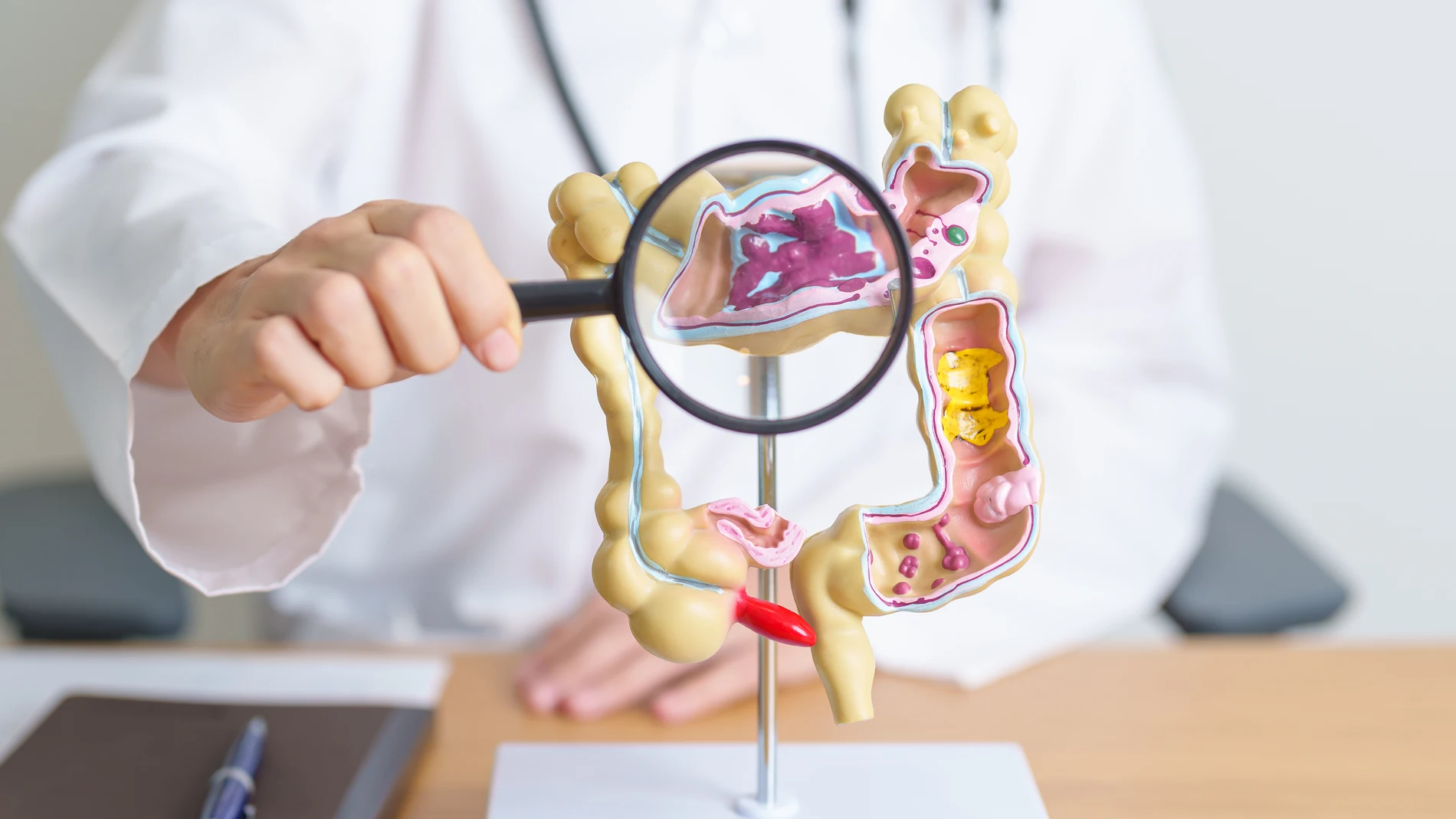 El cáncer colorrectal es el tumor maligno más frecuente en España y el segundo en la tasa de mortalidad