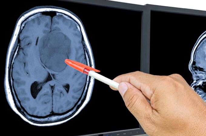 El glioblastoma es un tipo de tumor cerebral muy agresivo