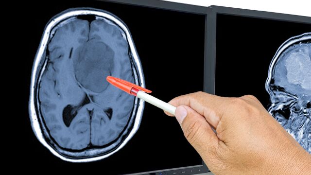 El glioblastoma es un tipo de tumor cerebral muy agresivo