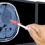 El glioblastoma es un tipo de tumor cerebral muy agresivo