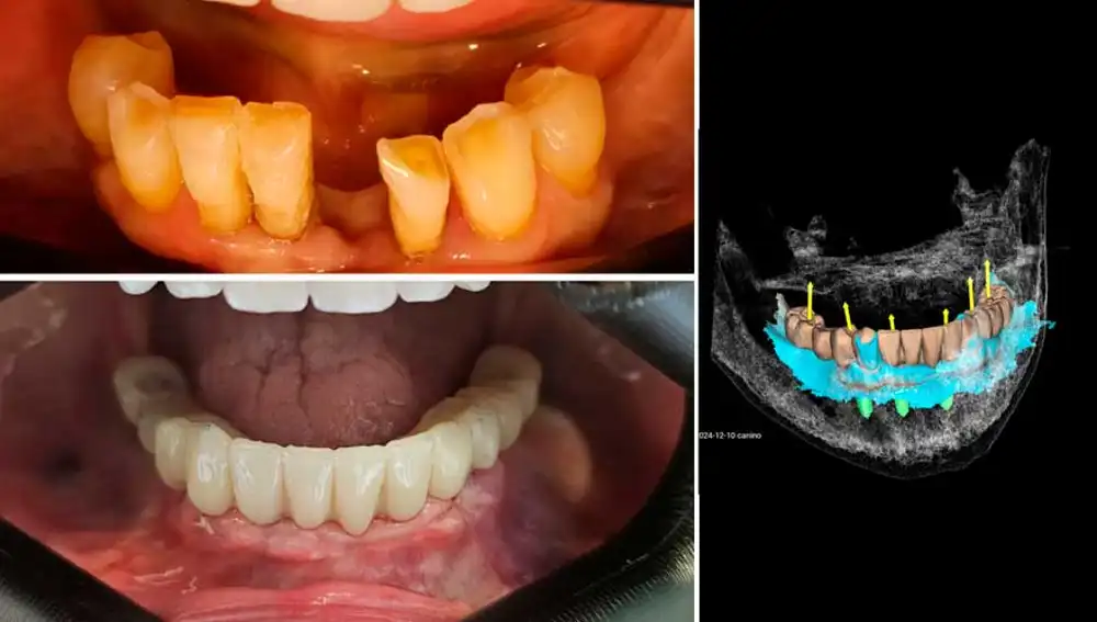 Ejemplo real: rehabilitación arcada inferior y Planificación 3D de un caso real