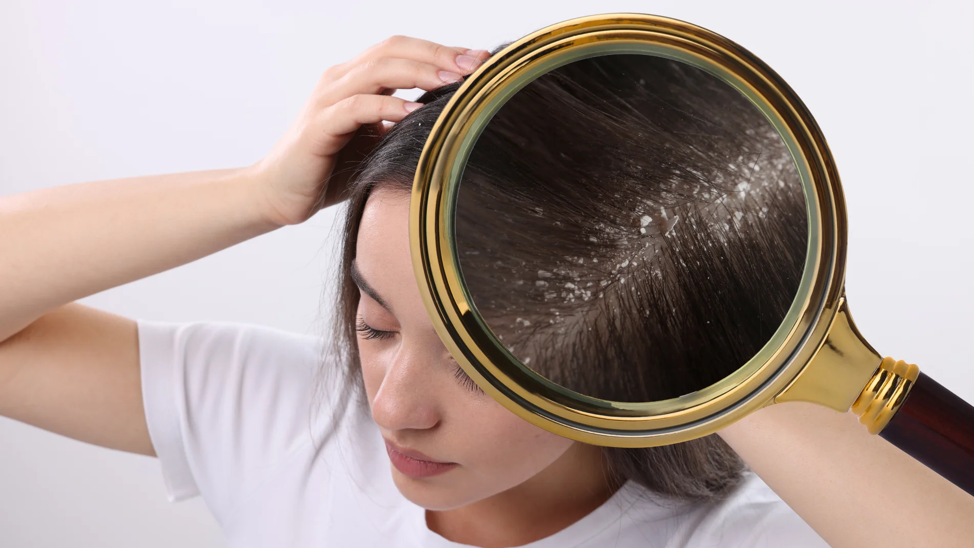 ¿Cada cuánto tiempo hay que lavarse el pelo si tienes caspa?